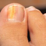 Mengapa kuku Anda menguning atau oranye : Ketahui dari para ahli