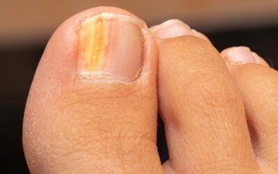 Por que suas unhas estão ficando amarelas ou laranjas: saiba por especialistas