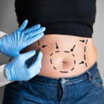 What Happens to The Weight That is Lost Through Liposuction?