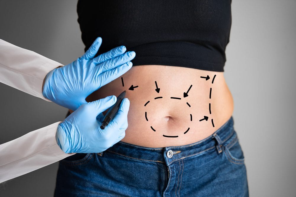 What Happens to The Weight That is Lost Through Liposuction?