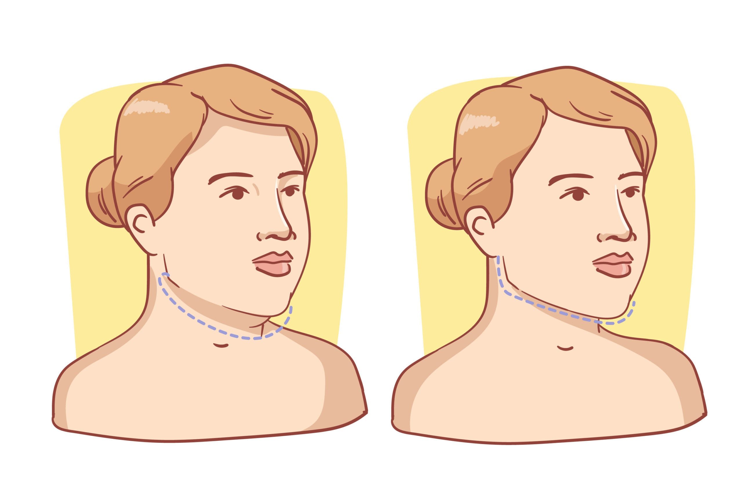 What Are The Best Ways To Reduce Double Chin Quickly?