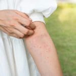 Bagaimana cara mengobati reaksi alergi terhadap cokelat palsu?