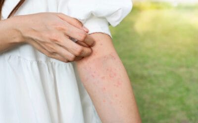 How To Treat Allergic Reaction To Fake Tan?